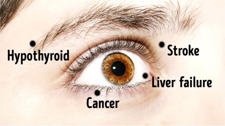 8 Things Your Eyes Say About Your Health