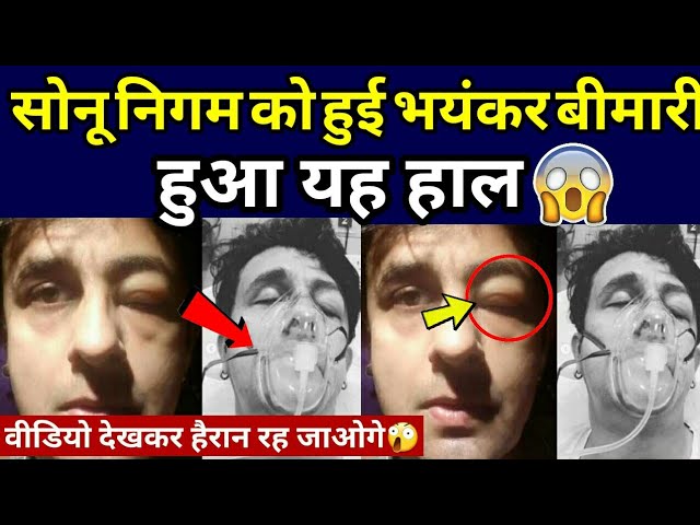 Bollywood,s Famous singer Sonu Nigam Health Is not Ok watch video.. Bollywood,s Famous singer Sonu Nigam Health Is not Ok watch video..