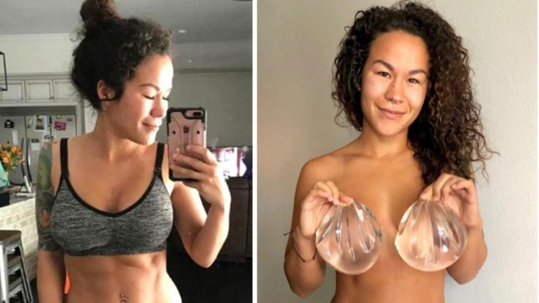 Why Fitness Influencer Chose to Remove Breast Implants Why Fitness Influencer Chose to Remove Breast Implants