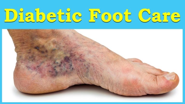 Diabetic Foot Problems: Symptoms, Treatment, and Care | ABC Health Diabetic Foot Problems: Symptoms, Treatment, and Care | ABC Health