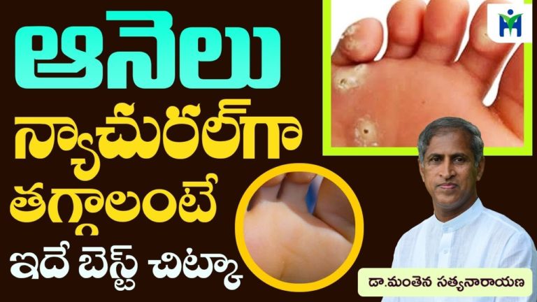 ఆనెలు నాచురల్ గా తగ్గాలంటే ఇదే బెస్ట్ చిట్కా | Manthena Satyanarayana Raju Videos | Health Mantra |