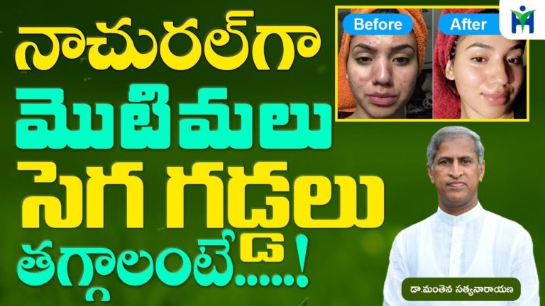 నాచురల్ గా మొటిమలు సెగ గడ్డలు తగ్గాలంటే|Manthena Satyanarayana Raju videos|health mantra|