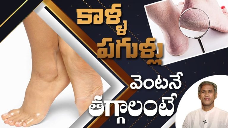 Home Remedies For Crack Heels | Health Tips In Telugu | Manthena Official Home Remedies For Crack Heels | Health Tips In Telugu | Manthena Official